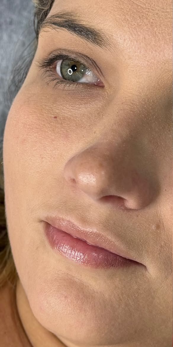 Preenchimento labial — antes