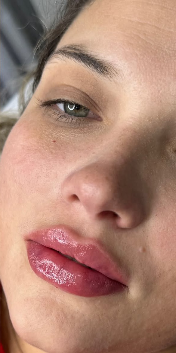Preenchimento labial — depois