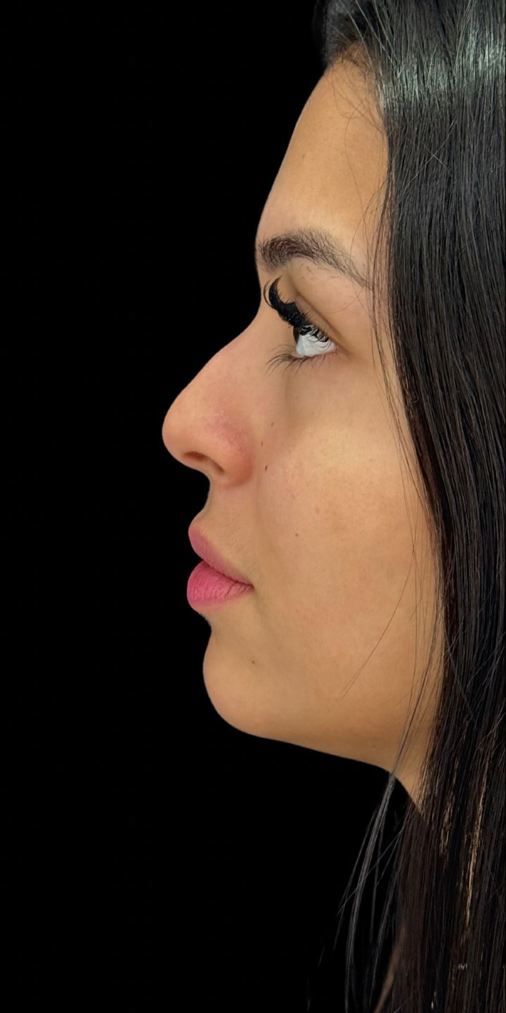 Harmonização facial — antes