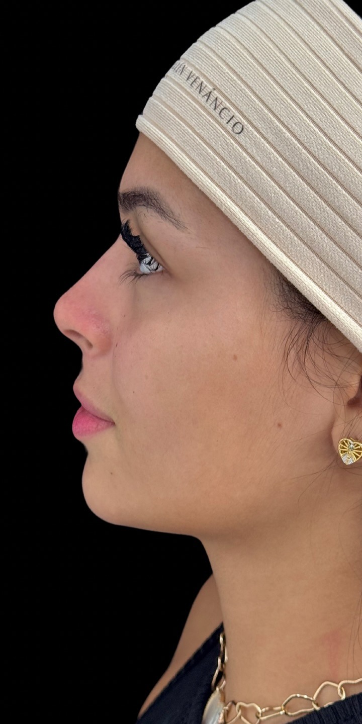 Harmonização facial — depois