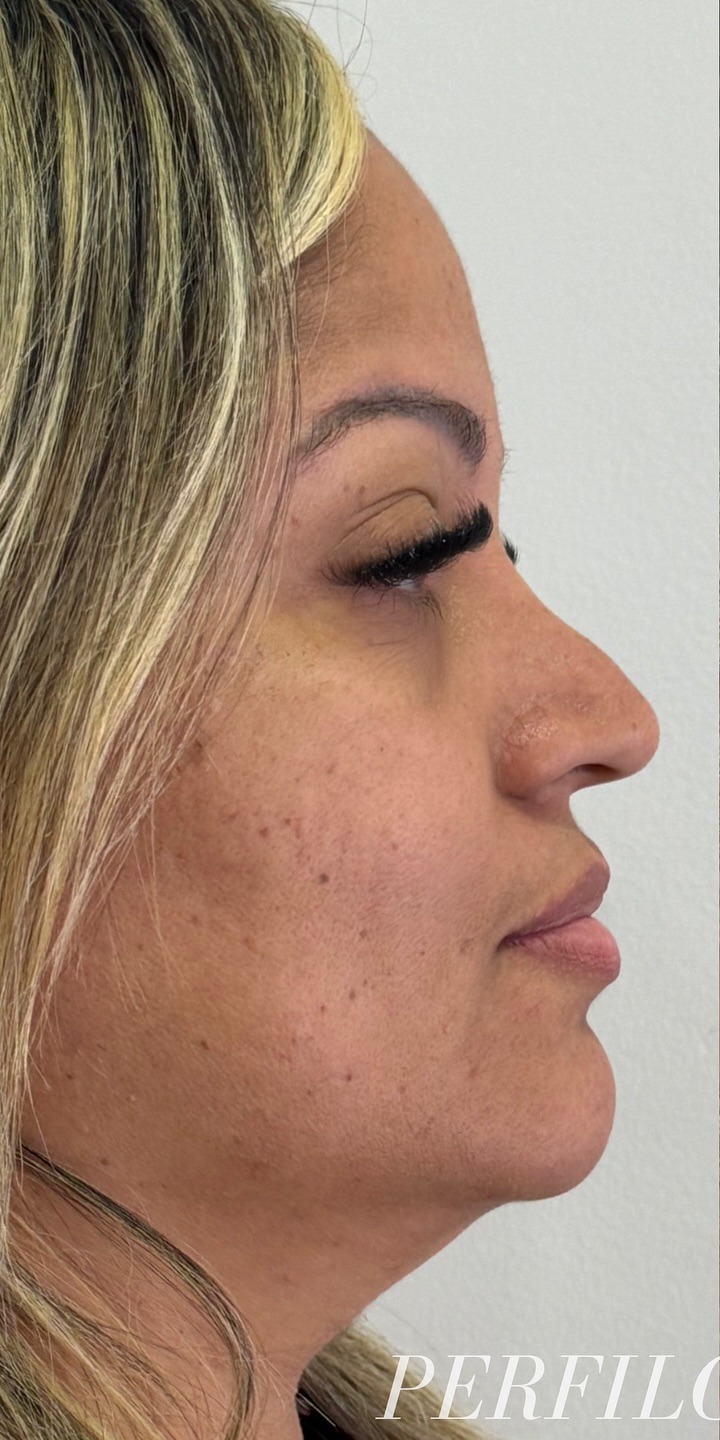 Perfiloplastia — antes