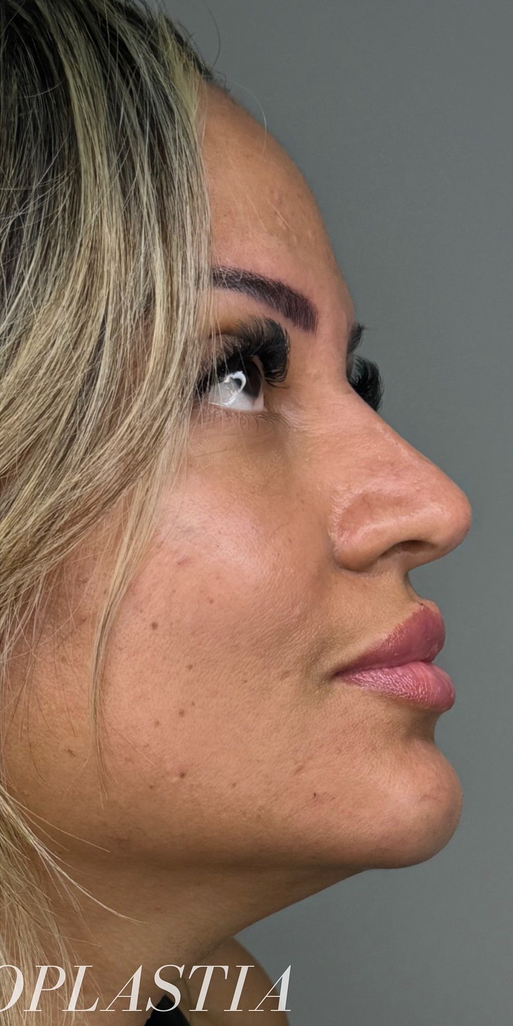 Perfiloplastia — depois